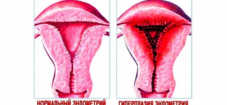 Гиперплазия эндометрия